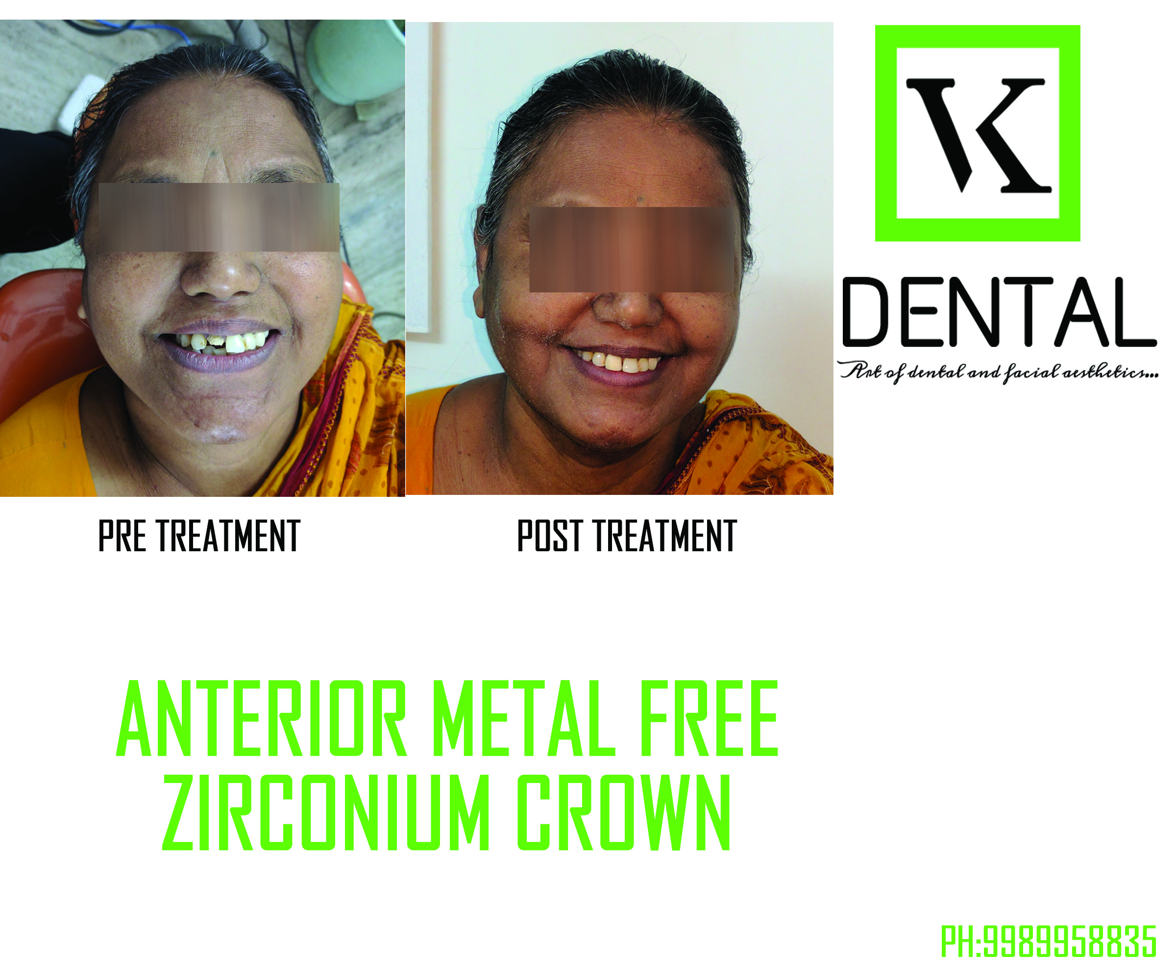 SMILE CORRECTION/DESIGNING